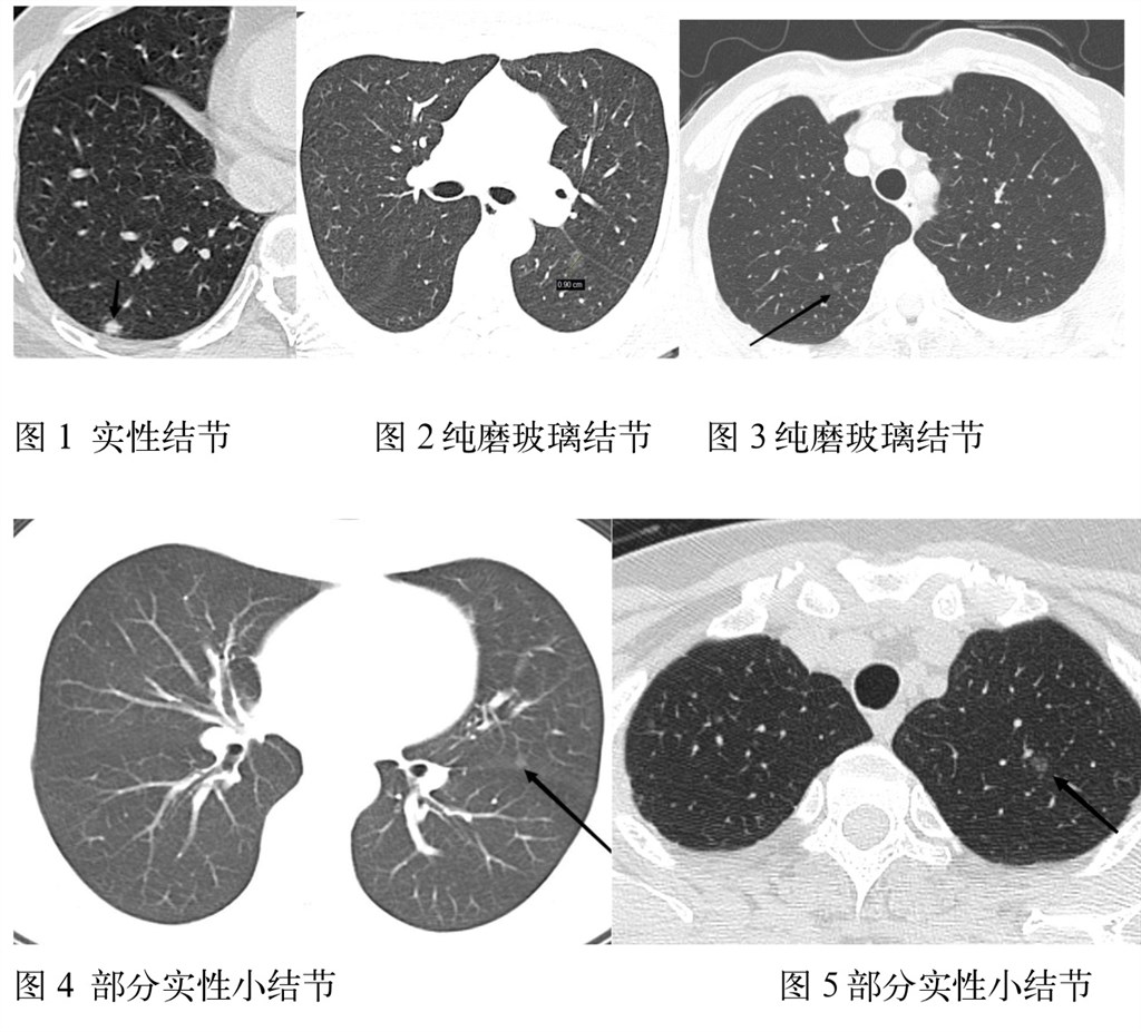 科普|查出肺小结节怎么办?